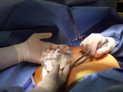 Ästhetische Chirurgie: Die Bedeutung der Brustverkleinerung