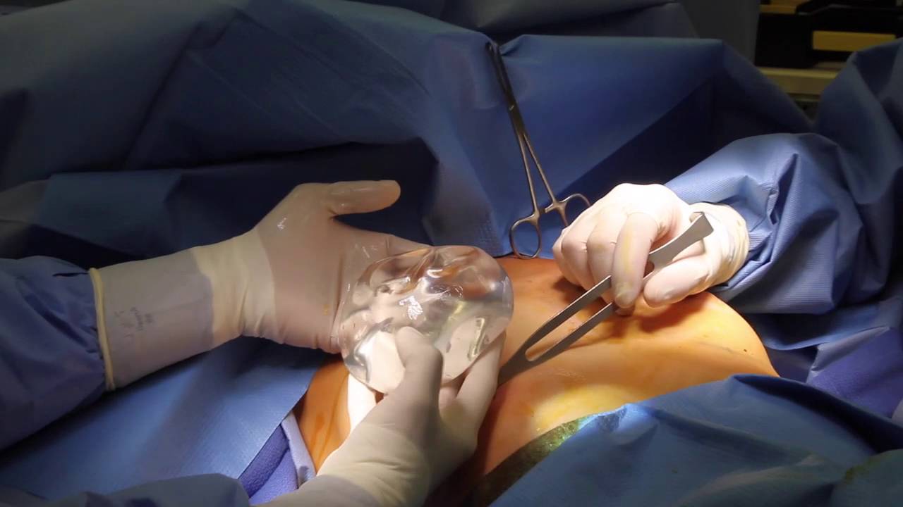 Ästhetische Chirurgie: Die Bedeutung der Brustverkleinerung